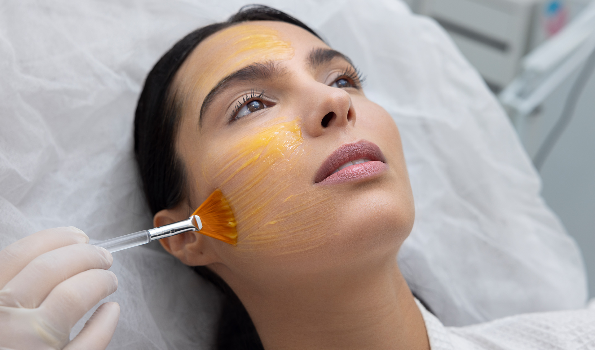 Hyperpigmentation Chemical Peel