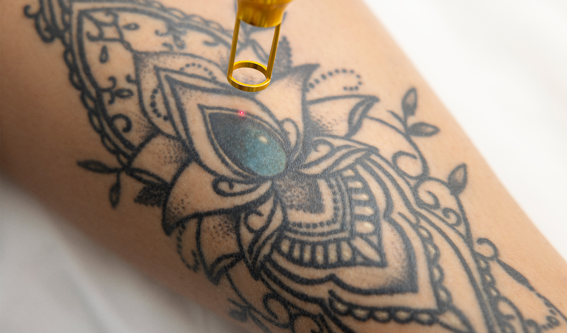 Laser Tattoo Removal