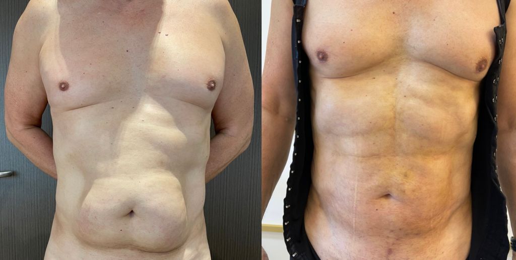 Liposuction HD